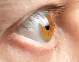 RGP Contact Lenses in Dubai Dr. Rahul Raghav Care, Dubai