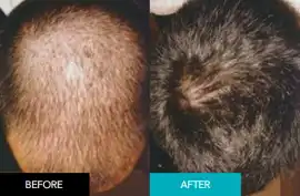 Leading Non-Surgical Integrated Hair System, Subiaco