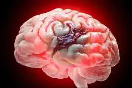 Trusted Brain Hemorrhage Operation with Expert Neu, Chandigarh