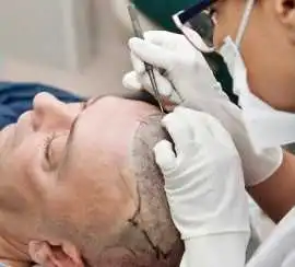 Affordable Hair Transplant in Turkey with IHLS, Subiaco
