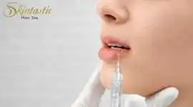 Best Lip Fillers Riverside for Smooth Lip, Riverside