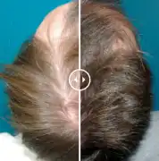 Client Transformations at a Top Hair Loss Clinic , Subiaco