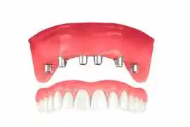Permanent Teeth Restoration: Dental Implants in Br, Bromley