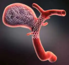 Aneurysm Coiling – Minimally Invasive Treatment, Mohali