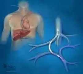 Transjugular Intrahepatic Portosystemic Shunt Trea, Mohali