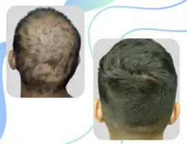 Success Stories in Effective Hair Treatment Perth, Subiaco