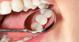 Dental Fillings from the Top Cosmetic Dentist AU, Ormeau