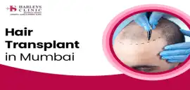 Advanced Hair Transplant in Mumbai by Expert Surge, Mumbai