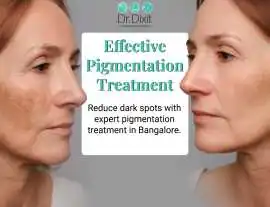 Pigmentation Treatment In Bangalore, Bengaluru
