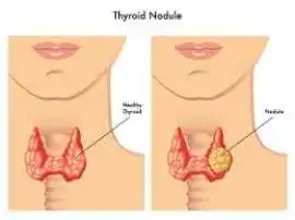 Non-Surgical Thyroid Nodule Treatment, Mohali