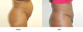 Facelift Before and After Results, San Francisco