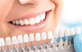 Best Teeth Whitening Service Doctors in Ahmedabad , Ahmedabad