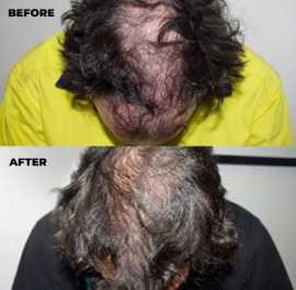 Book a Doctor for Hair Loss Treatment WA, Subiaco