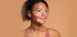 Home Remedies for Vitiligo Diseases, Gurgaon