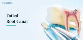 Root Canal Treatment : Procedure, Benefits, Ahmedabad