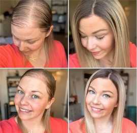 Hair System from Hair Regrowth Experts Perth, Perth