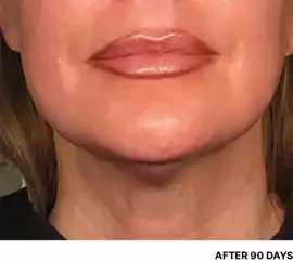 Ultherapy cost in Delhi, Delhi