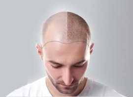 Discover Hair Transplantation Cost in Jaipur, Jaipur