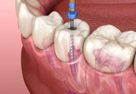 Best Root Canal Dentist in Hayward, Hayward