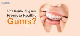 Transform Your Smile with Clear Aligners , Ahmedabad