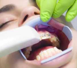 Affordable Dental Implants Fort Worth, Fort Worth