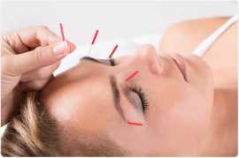 Acupuncture Treatments in London , London