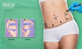 Tummy tuck and liposuction surgery in Bangalore , Bengaluru
