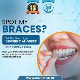 Achieve a Perfect Smile with Aligners from Dentist, Ahmedabad