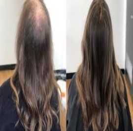 Best Hair Regrowth Treatment Birmingham, UK, Sutton Coldfield