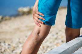 Finding The Best Vein Treatment Specialist In Cali, San Diego