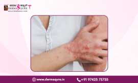 Effective Lichen Planus Treatment in Bangalore, Bengaluru