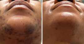 Get Professional Pigmentation Treatment in Cairns, Cairns