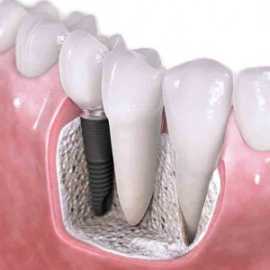 Dental Implants and Cost In Noida, Noida