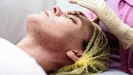 Photodynamic Therapy LED Facial Orlando, Orlando