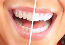 Deep Teeth Cleaning for a Healthier Smile, Euless
