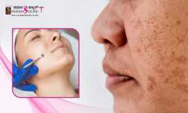 Best Open Pores Treatment in Bangalore, Bengaluru