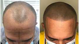 Scalp Micropigmentation The Ultimate Hair Loss Fix, Lucknow