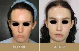 Transgender Surgery Cost in India, Mumbai