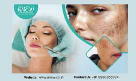 Hyperpigmentations Treatment in Bangalore, Bengaluru
