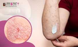 Effective Skin Psoriasis Treatment in Bangalore, Bengaluru