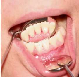 Get a Confident Smile with Invisalign Mississauga , Mississauga