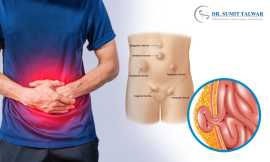 Dr. Sumit: Expert in Obese Hernia Repairs, Bangalo, Bengaluru