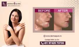 Advanced Vitiligo Treatment in Bangalore, Bengaluru