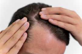 Affordable Hair Transplant in Gorakhpur , Lucknow