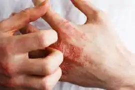 Trusted Legal Help for Occupational Dermatitis , Bolton