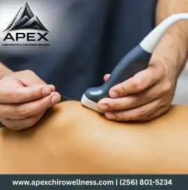 Dry Needling in Huntsville | Apex Chiropractic & F, Huntsville