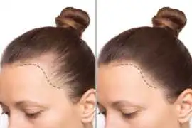 Scalp Tattoo For Thinning Hair - Natural-Looking, Vancouver