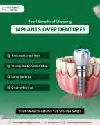 Premium Dental Implants in Noida , Noida