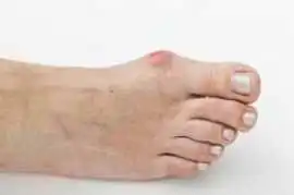 The Role of Genetics in Foot Bunion Formation, Novena