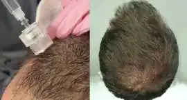 Experience Future of Hair Restoration with Exosome, Subiaco